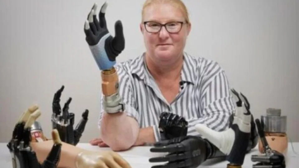 Σουηδία: Η πρώτη «βιονική» γυναίκα στον κόσμο διαθέτει ρομποτικό χέρι που «ενσωματώνεται» στον σκελετό