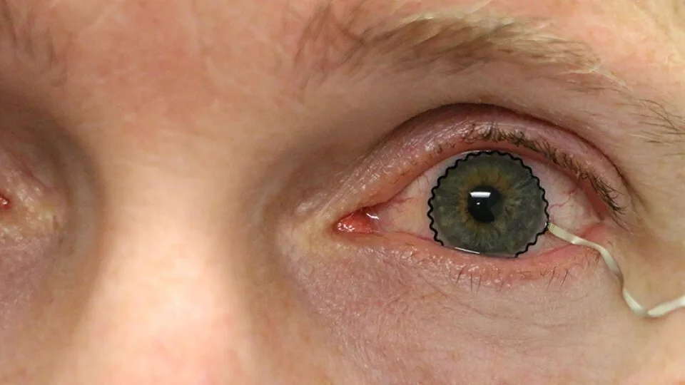 Νέοι μαλακοί φακοί επαφής βοηθούν στη διάγνωση παθήσεων των ματιών